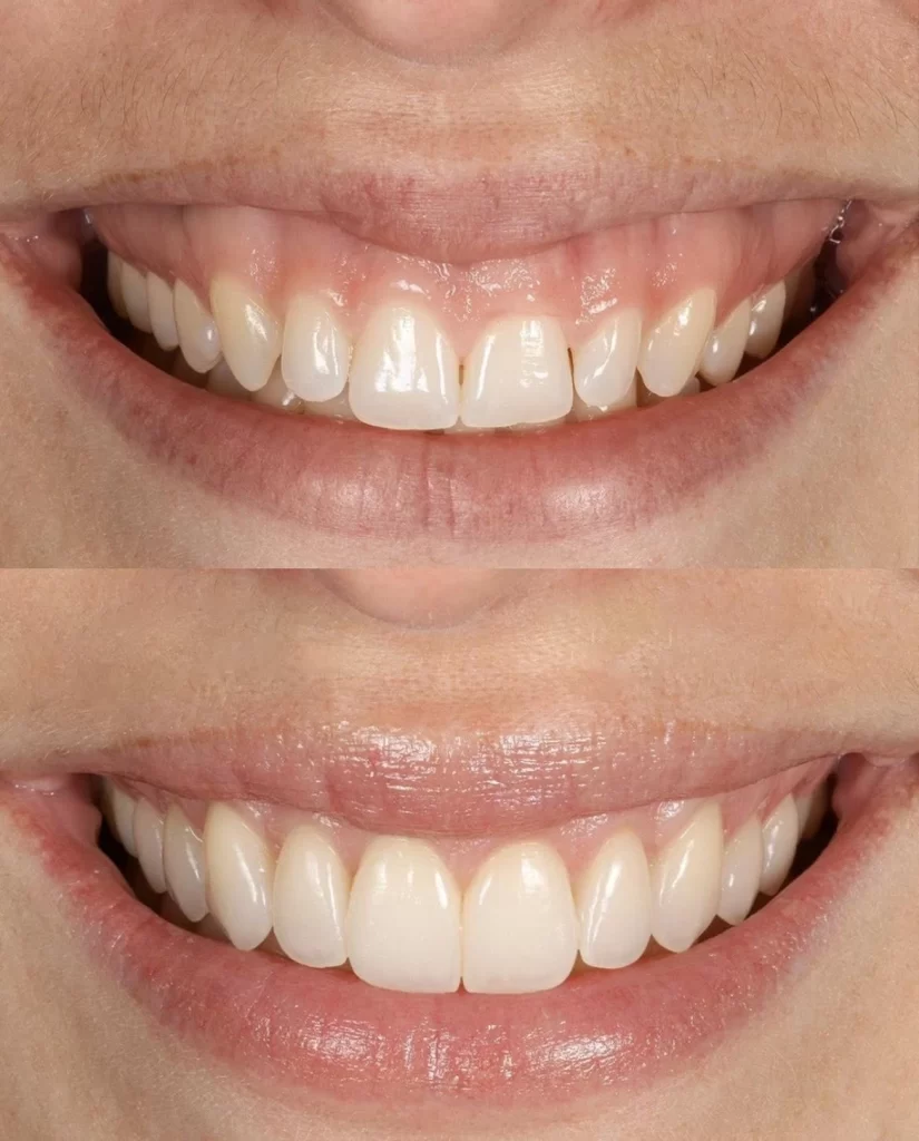 Gum Therapy Before and After