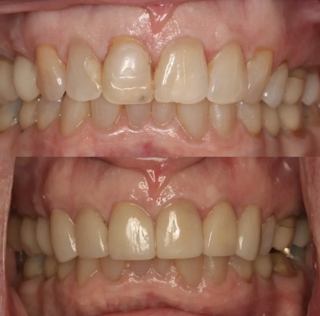 Teeth Reconstruction