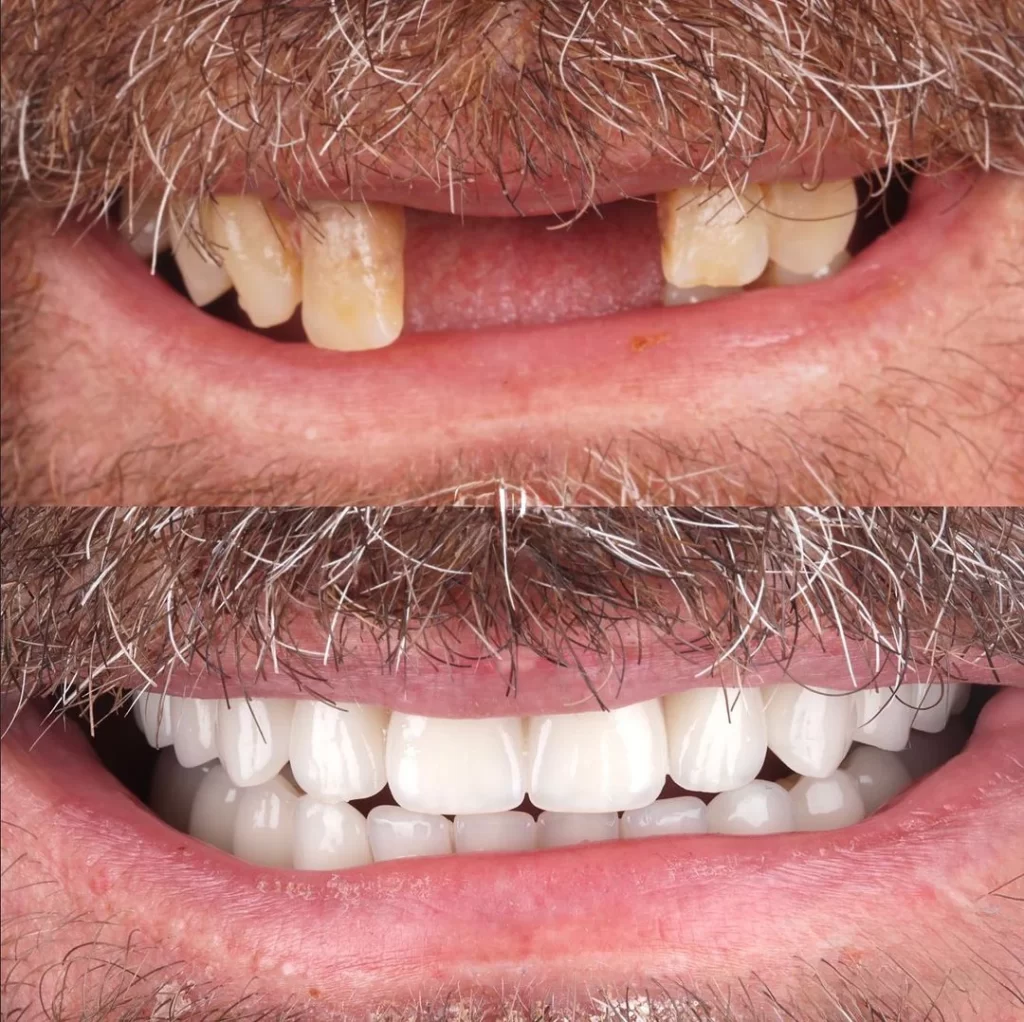 All on 4 Dental Implants Before and After