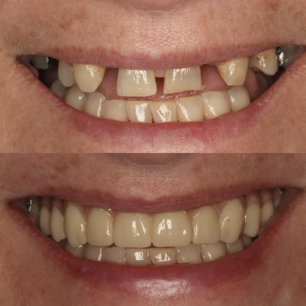 All on 4 Dental Implants Before and After